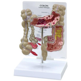GPI Anatomicals cut-away colon model with pathologies