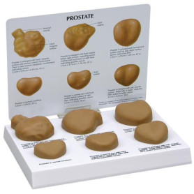 GPI Anatomicals set of 6 prostate model with pathologies